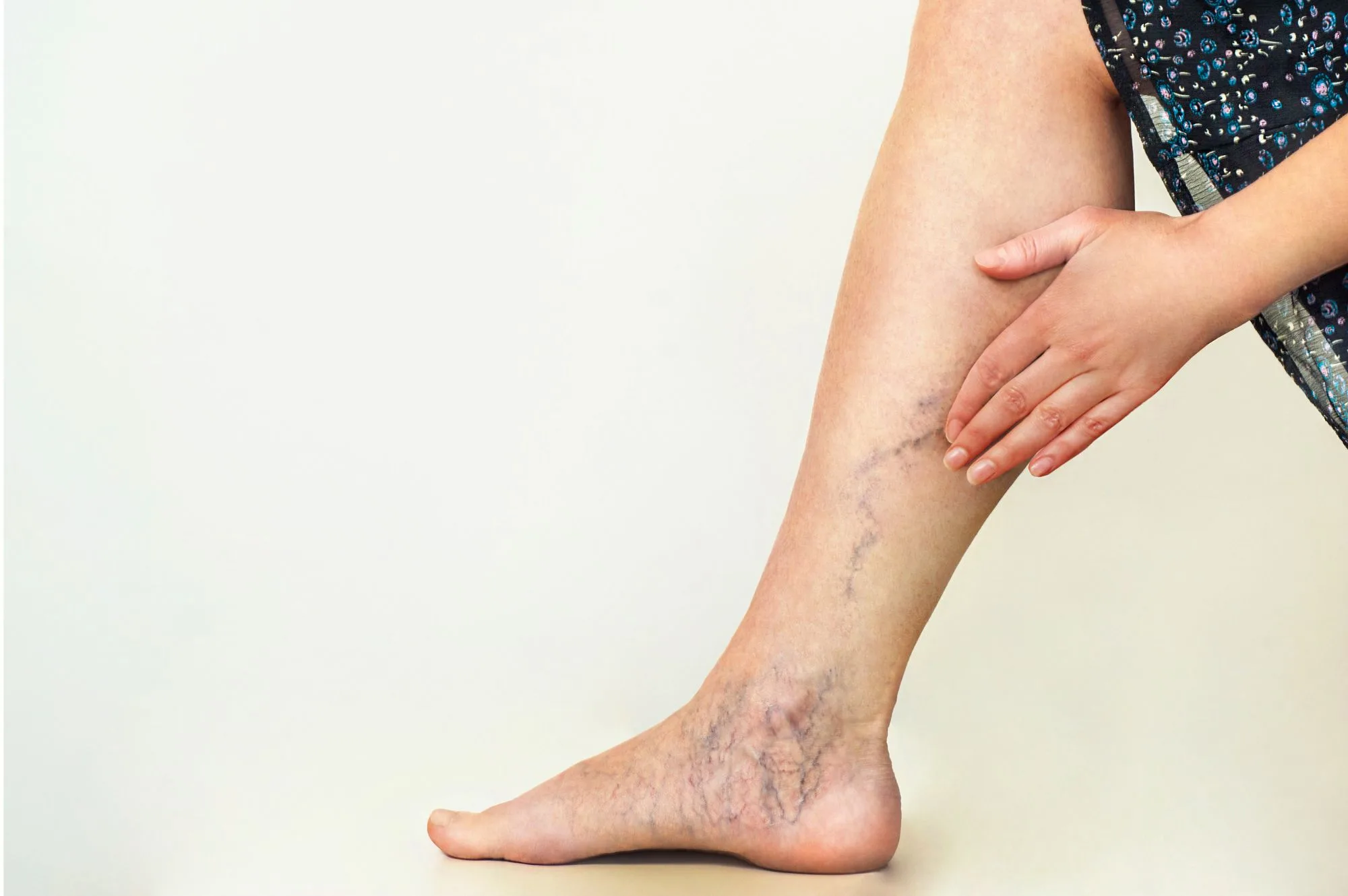 Get rid of Varicose Veins with message therapy